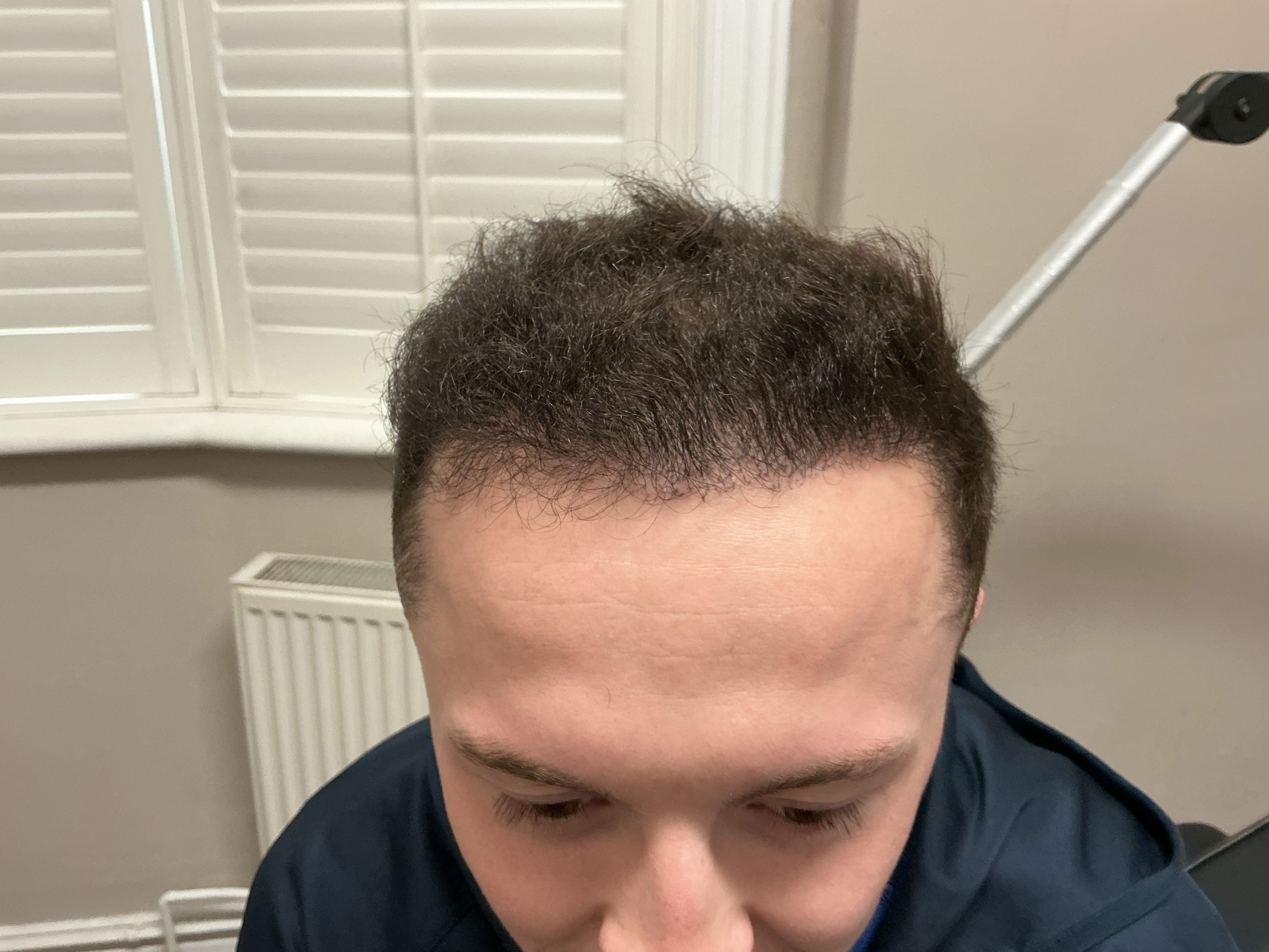 Advanced hairline recession — result photo 10